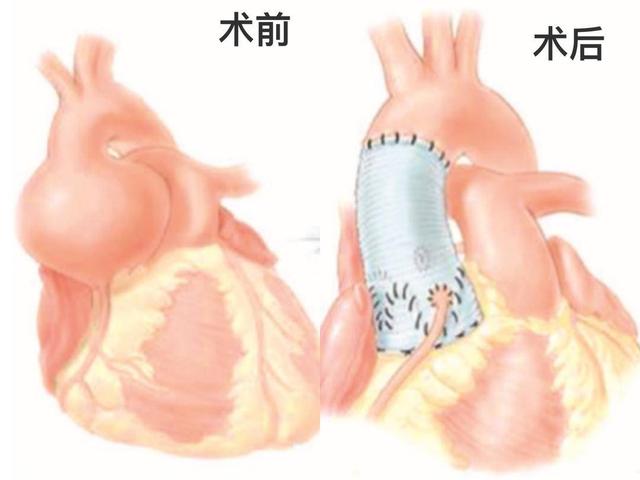 警惕！省人医一周收治7例急性A型主动脉夹层患者