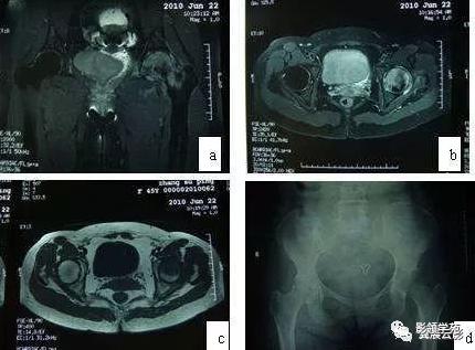 10种类似股骨头坏死的髋关节疾病的鉴别诊断