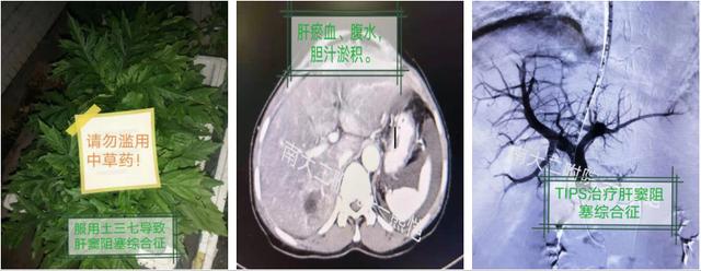 南昌大学第二附属医院消化内科2020年TIPS首破百例再创新高