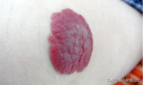 你的育儿经|新生儿屁股淤青怎么回事？如果属于这三种“胎记”记得看医生