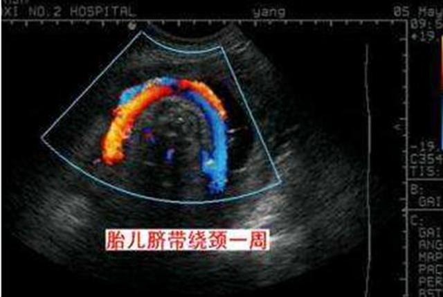 凉年|孕期胎动是宝宝的求救信号？很多孕妈都忽略了，三种情况不能忽视