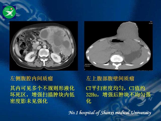 李健丁教授：胃肠道外间质瘤的CT表现和临床病理分析