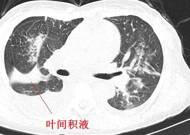 「典型」的肺水肿，为何用抗生素狂轰滥炸？