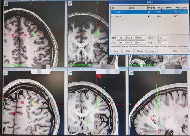 “重启”大脑走出“精神迷宫”，立体定向手术让两个家庭露出久违的微笑