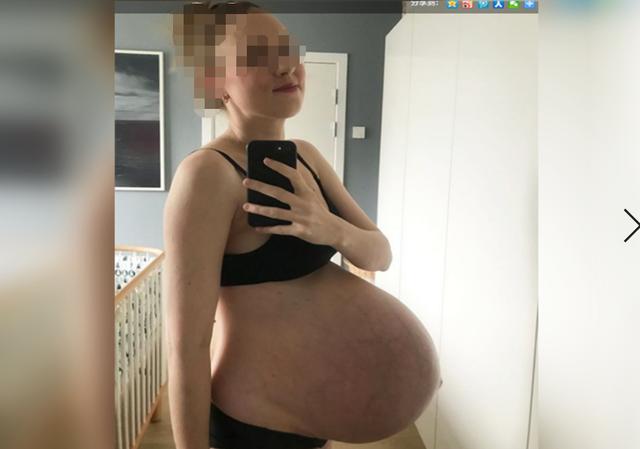 婉转应和|孕妈“子弹肚”走红,网友猜测多胞胎,医生:不要太乐观