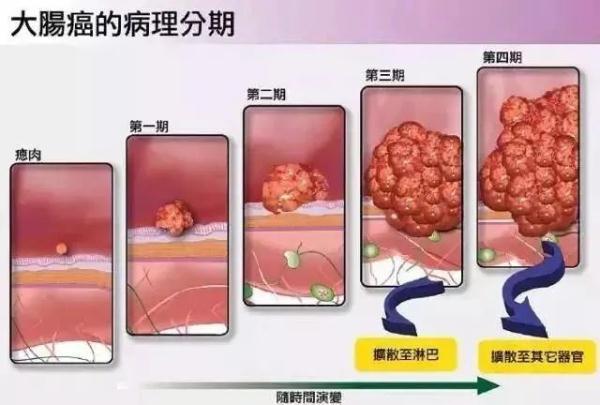 患者|每小时3人得癌！最新深圳肿瘤榜，头号杀手仍是它……这些习惯要赶紧戒