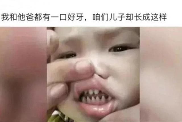 「超级宝妈」儿子长“鲨鱼牙”走红，又长又尖锐像小钉子，医生：父母太无知
