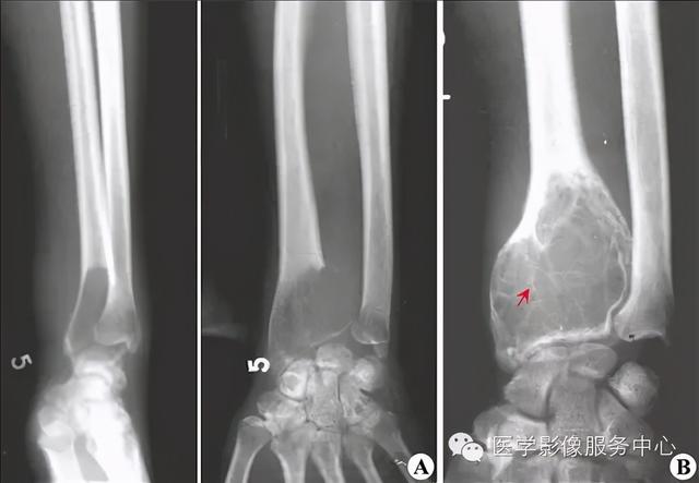 收藏 |：79种典型骨肌影像病例，助你诊断无忧