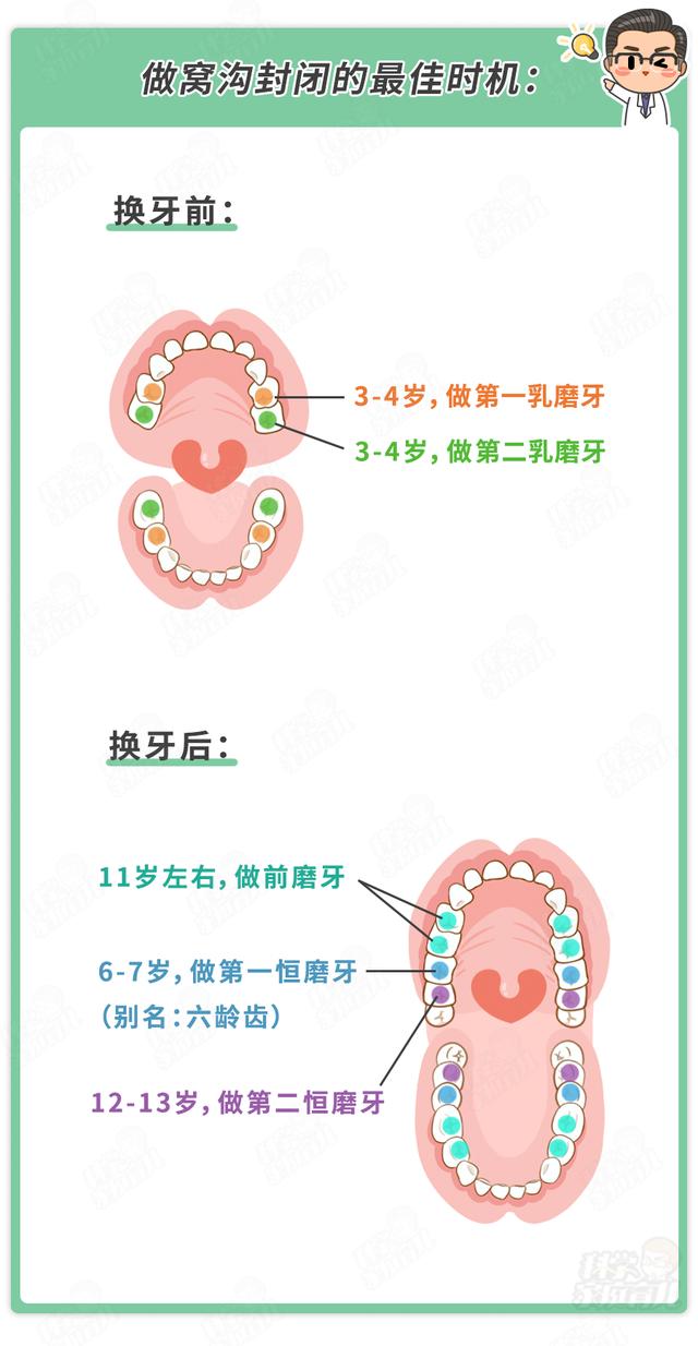 幸福相守|有些事牙科医生不轻易告诉你!窝沟封闭≠一劳永逸!后续做好3事
