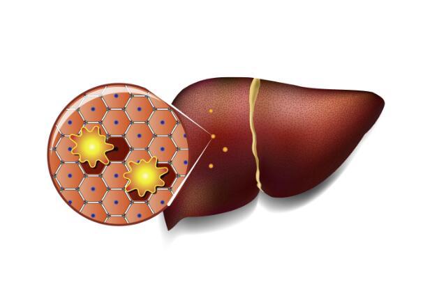 脂肪肝是吃出来的，饮食注意这4点，吃对了，肝脏会感激你