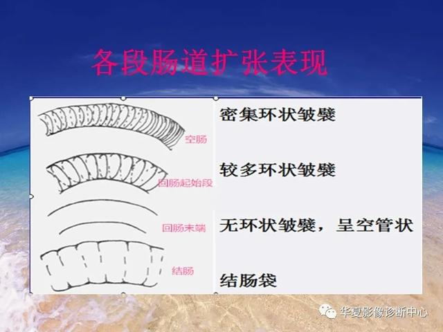 消化道穿孔的CT诊断