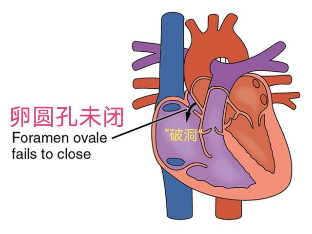 50岁女性3个月两次脑梗，抽丝剥茧，原来心脏有个“破洞”