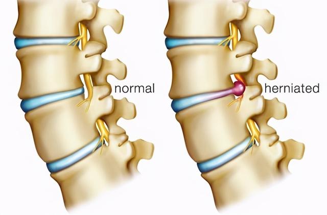 腰椎间盘突出症什么时候手术效果更好？