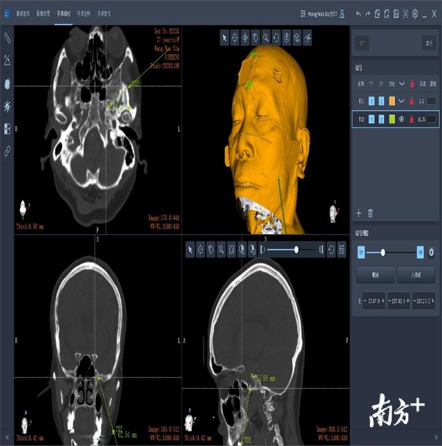 机器人为患者做手术？南山医院神经外科实施机器人精准治疗