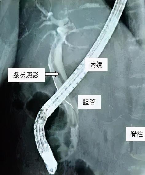 女子被怪病折磨近一个月，体内取出22cm长蛔虫