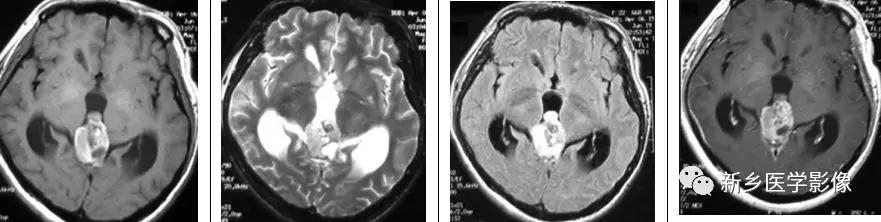 12种松果体区肿瘤的影像表现