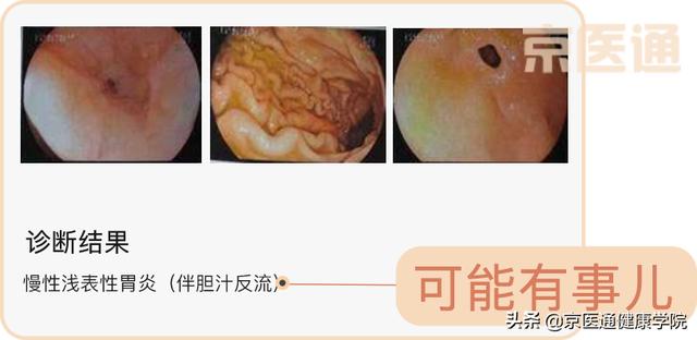 胃炎、肠化离胃癌有多远？教你快速读懂胃镜报告