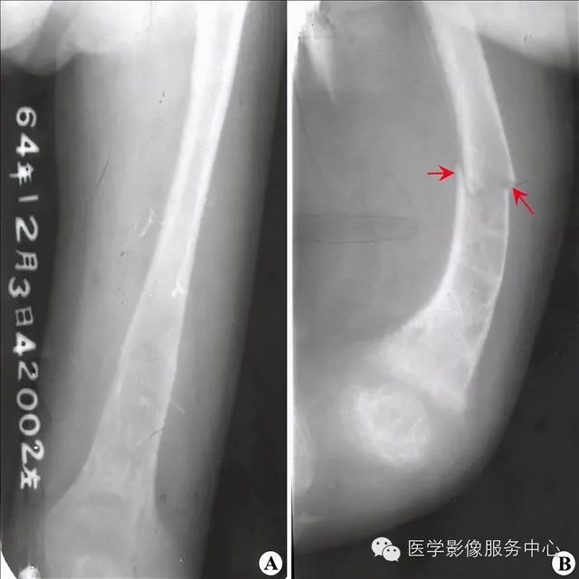 收藏 |：79种典型骨肌影像病例，助你诊断无忧