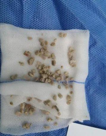 7岁女孩体内取出百颗结石，只因一年前这个动作，别让它毁掉孩子