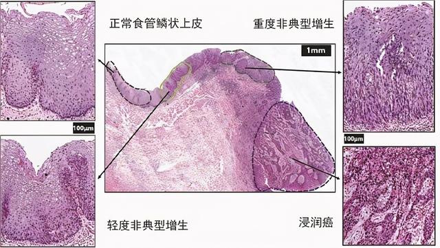 食管癌的癌前病变