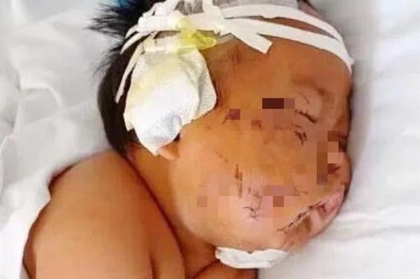 【超级宝妈】5年前男婴吃奶时咬疼妈妈，被妈妈划伤脸蛋，现在的他怎样了？