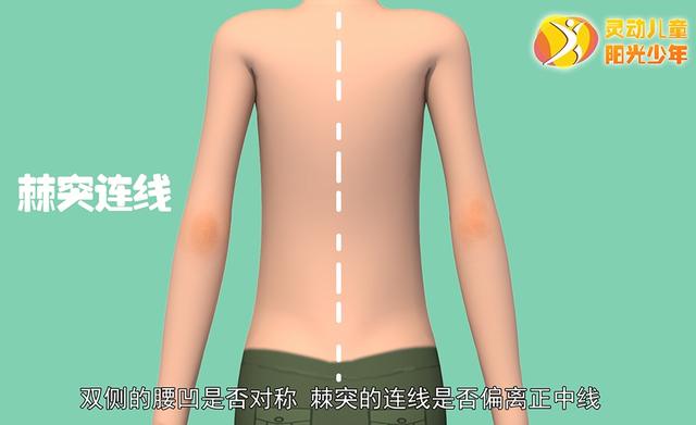 健康学堂|孩子高低肩，可能是病，这些脊柱侧凸自查方法，家长们一定要收藏