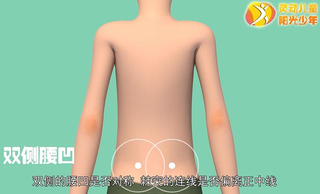 健康学堂|孩子高低肩，可能是病，这些脊柱侧凸自查方法，家长们一定要收藏