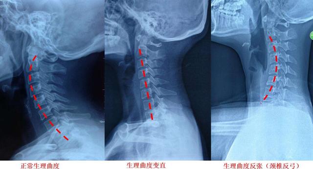 后背疼、紧、僵硬怕冷，是受凉导致的？医生辟谣，讲清肌筋膜炎