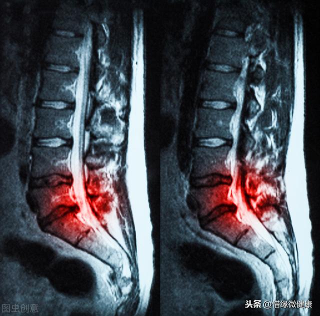 重新认识腰间盘突出，及康复方案