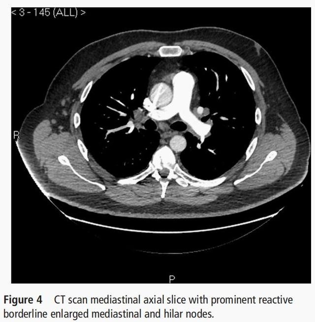 呼吸困难多次被误诊，只因一床被子？