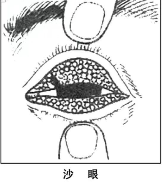 眼睛|「双语」健康用眼，你做到了吗？