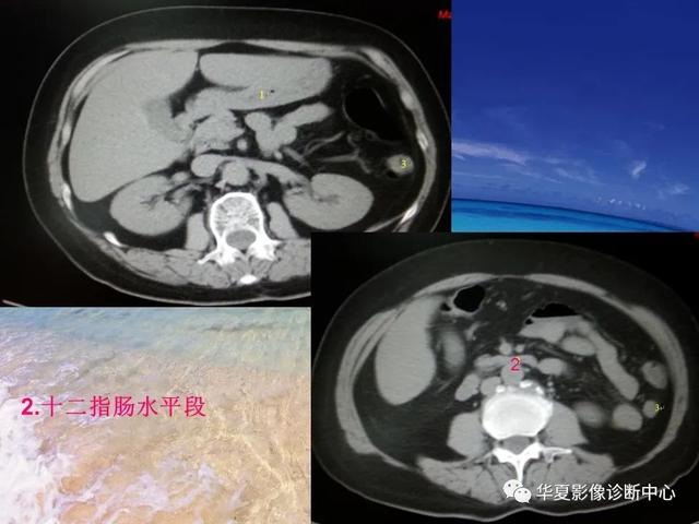 消化道穿孔的CT诊断