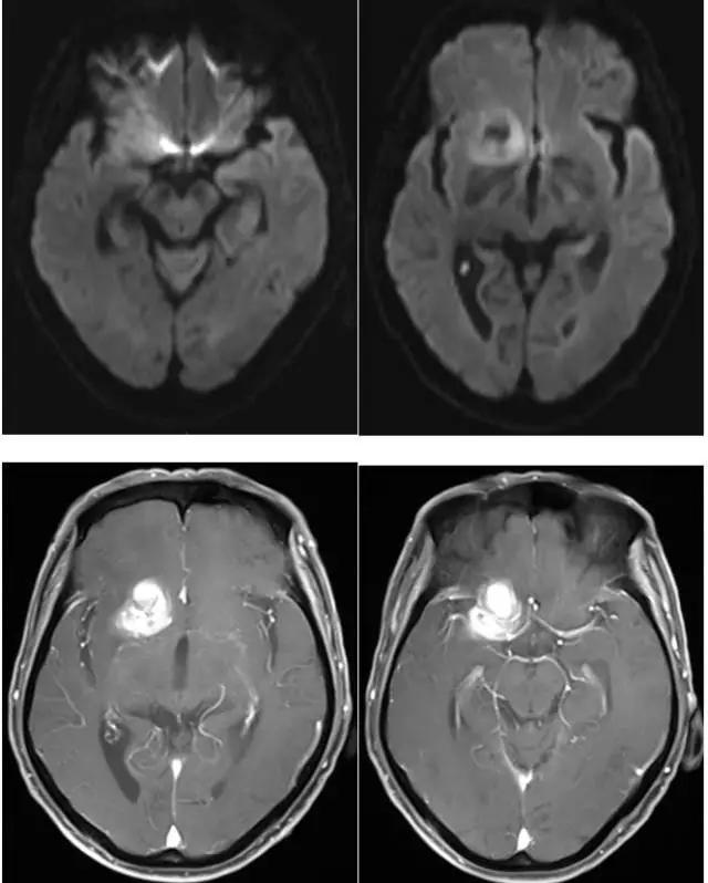颅内原发性淋巴瘤的影像诊断要点
