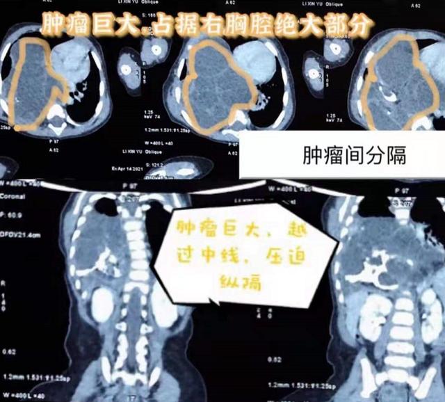 肿瘤|7月大女婴不爱吃奶吃啥吐啥，一查竟是胸中长了个“怪胎”