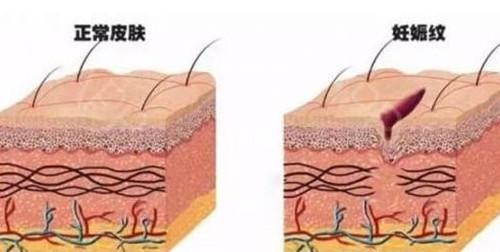 你的育儿经：妊娠纹是怎么产生的？网友用塑料袋像大家展示，简直不要太形象
