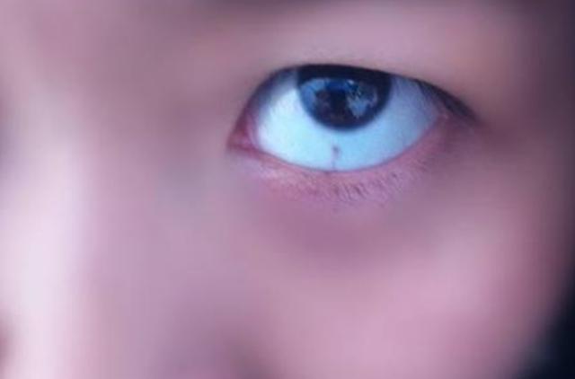 『超级宝妈』孩子眼白有“黑点”是咋回事？大多是这3种原因作祟，医生：别慌