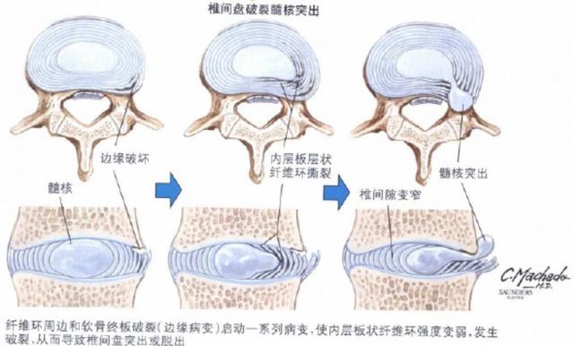 腰椎曲度越直，腰越疼？腰椎生来是弯的吗？医生帮您辟谣