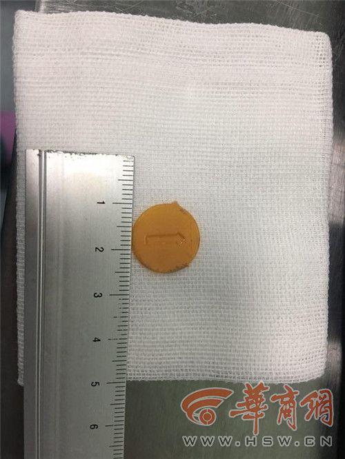 【超级宝妈】山西2岁女孩误吞塑料薄片长时间未发现 远赴西安急求医