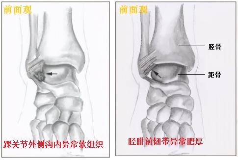 【卫生社团】踝关节疼痛别大意，警惕踝关节撞击综合征！