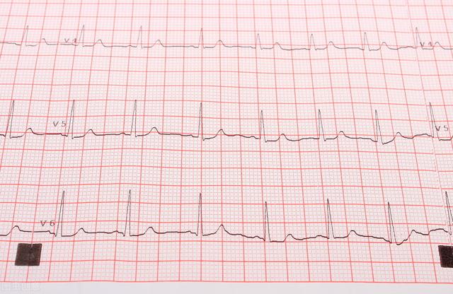 体检发现“窦性心律”，是怎么回事？是病吗？心血管医生详细解答