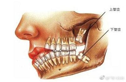 智齿|智齿，究竟是怎么回事？