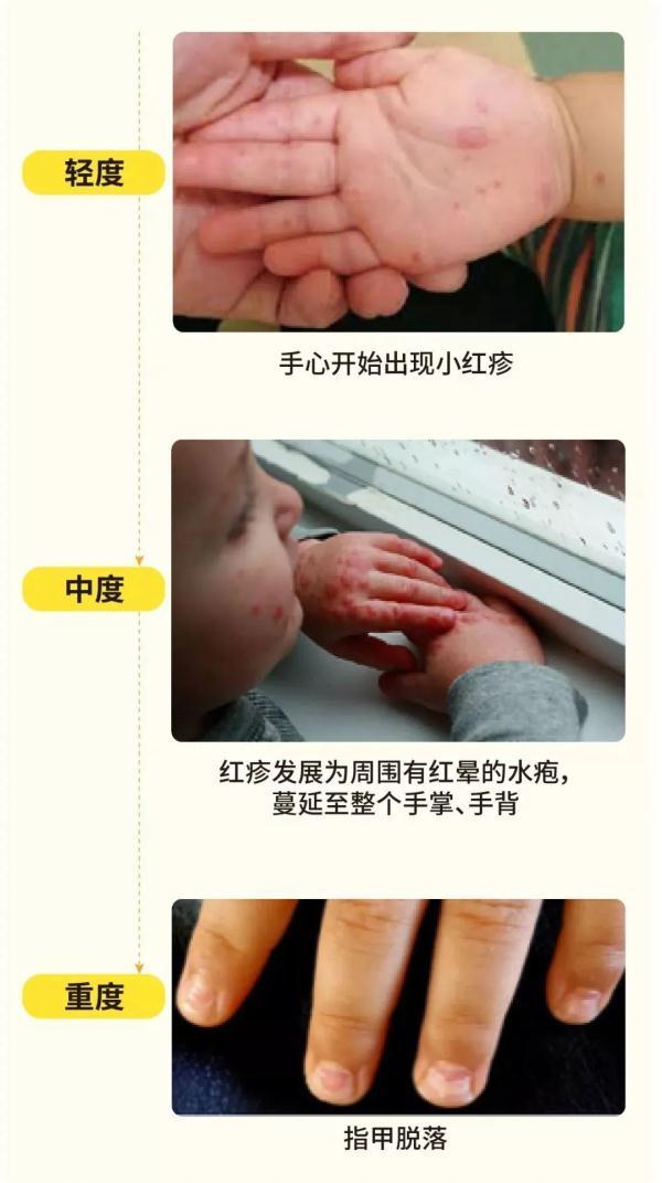 手足|发现孩子手脚出现这种情况要当心了，这种无特效药的传染病正高发