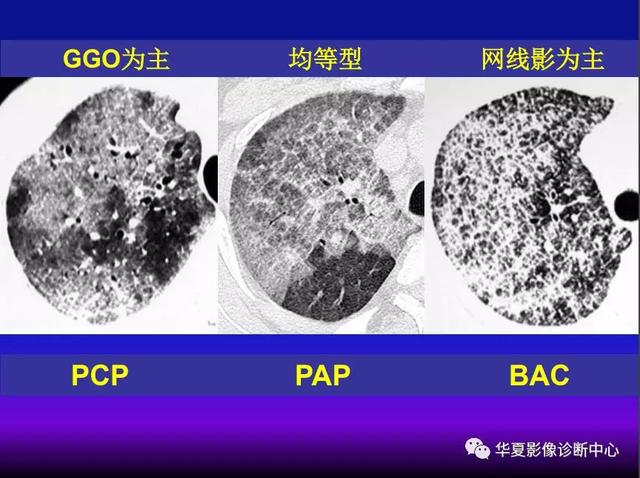 肺间质性疾病的解剖、病理、影像分析