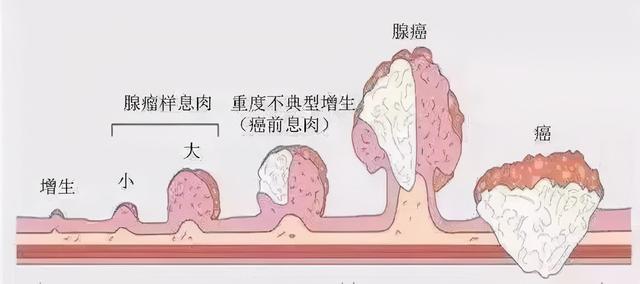 我45岁，坚持锻炼，排便正常，怎么查出了结肠癌？