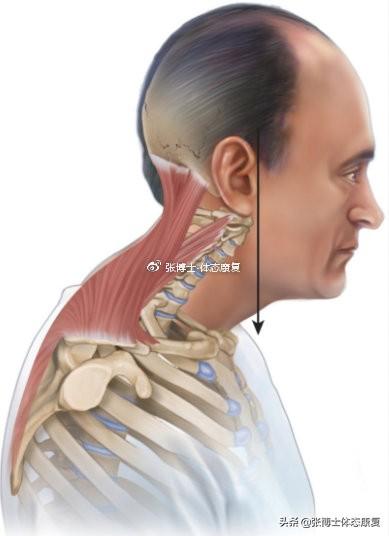 肌肉疲劳|「体态矫正」慢性颈肩痛，或许与你有头前伸的不良体态有关