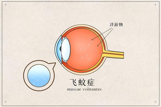 眼睛总是看到蚊子，如何治疗？有3种治疗方法，可以帮到你