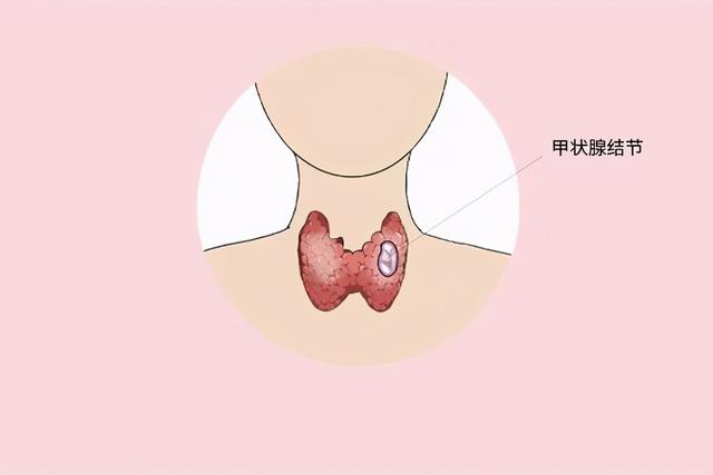 结节是肿瘤吗？肿瘤和癌症有什么区别？医生今天给您科普下