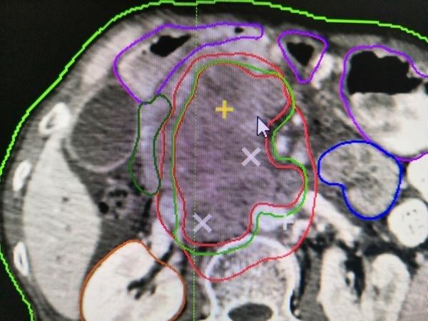 肿瘤|男子年近六旬患上儿科常见肿瘤，伽玛刀治疗为他抓住“生机”