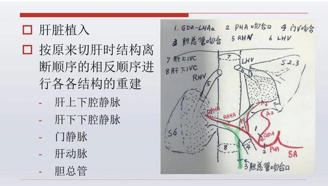 肝脏|深圳首例！肝脏“掏”出离体10小时，切除肿瘤再“种”回去