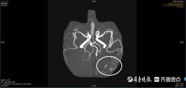 “颅内炸弹”引发脑出血，烟台山医院多学科合作为患者“拆弹”